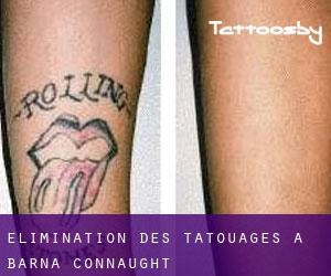 Élimination des tatouages à Barna (Connaught)