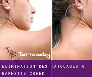 Élimination des tatouages à Barnetts Creek