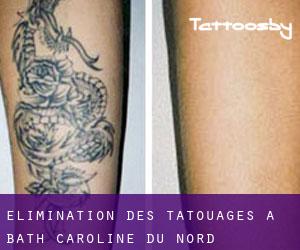 Élimination des tatouages à Bath (Caroline du Nord)