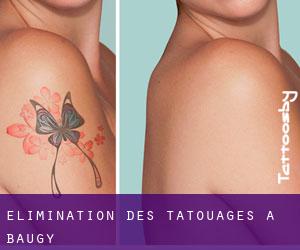 Élimination des tatouages à Baugy