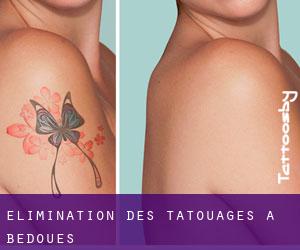 Élimination des tatouages à Bédouès