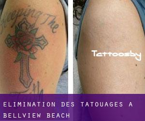 Élimination des tatouages à Bellview Beach