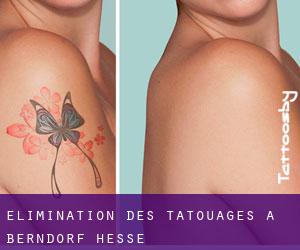 Élimination des tatouages à Berndorf (Hesse)