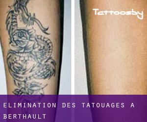 Élimination des tatouages à Berthault