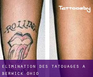 Élimination des tatouages à Berwick (Ohio)