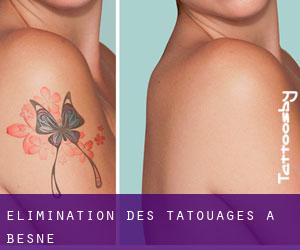 Élimination des tatouages à Besné