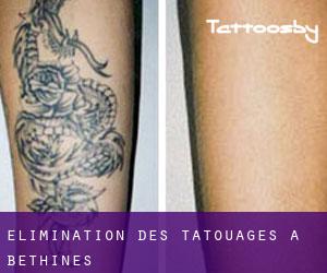 Élimination des tatouages à Béthines