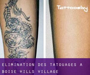 Élimination des tatouages à Boise Hills Village