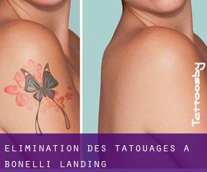 Élimination des tatouages à Bonelli Landing