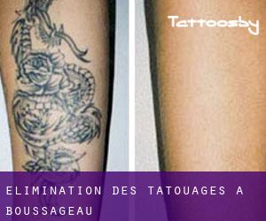 Élimination des tatouages à Boussageau