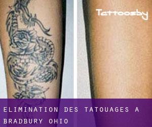 Élimination des tatouages à Bradbury (Ohio)