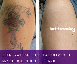 Élimination des tatouages à Bradford (Rhode Island)