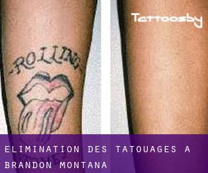 Élimination des tatouages à Brandon (Montana)