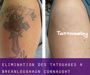 Élimination des tatouages à Breanloughaun (Connaught)