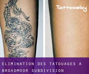 Élimination des tatouages à Broadmoor Subdivision