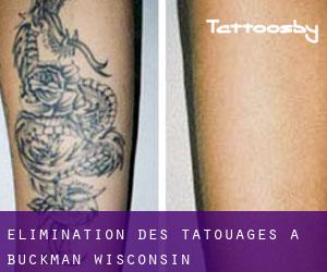 Élimination des tatouages à Buckman (Wisconsin)