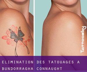 Élimination des tatouages à Bundorragha (Connaught)