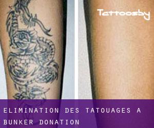 Élimination des tatouages à Bunker Donation