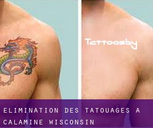 Élimination des tatouages à Calamine (Wisconsin)