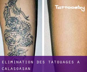 Élimination des tatouages à Calasgasan