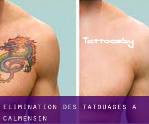 Élimination des tatouages à Calmensin