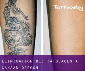 Élimination des tatouages à Canaan (Oregon)