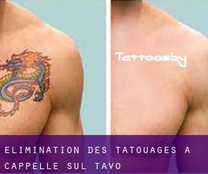 Élimination des tatouages à Cappelle sul Tavo