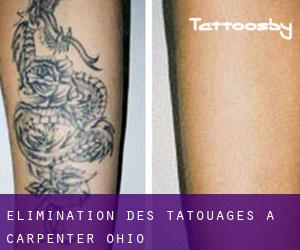 Élimination des tatouages à Carpenter (Ohio)