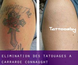 Élimination des tatouages à Carraroe (Connaught)