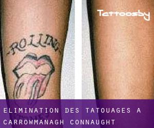 Élimination des tatouages à Carrowmanagh (Connaught)