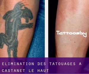 Élimination des tatouages à Castanet-le-Haut