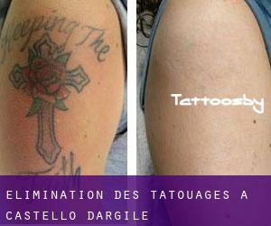 Élimination des tatouages à Castello d'Argile