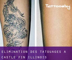 Élimination des tatouages à Castle Fin (Illinois)