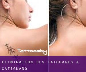 Élimination des tatouages à Catignano