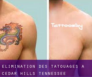 Élimination des tatouages à Cedar Hills (Tennessee)