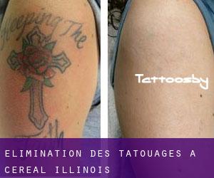 Élimination des tatouages à Cereal (Illinois)