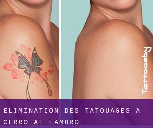 Élimination des tatouages à Cerro al Lambro