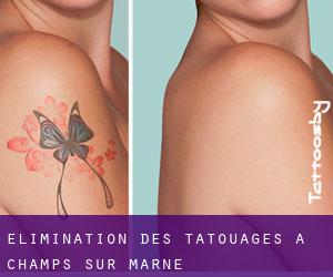 Élimination des tatouages à Champs-sur-Marne