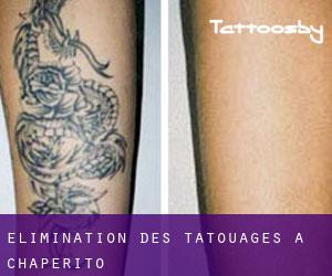 Élimination des tatouages à Chaperito