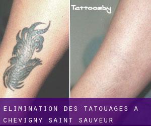 Élimination des tatouages à Chevigny-Saint-Sauveur