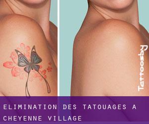 Élimination des tatouages à Cheyenne Village