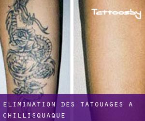 Élimination des tatouages à Chillisquaque