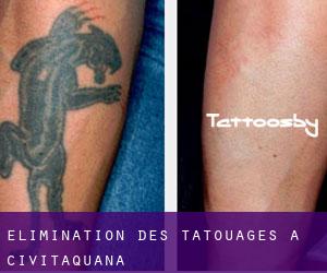 Élimination des tatouages à Civitaquana