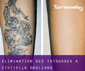 Élimination des tatouages à Civitella d'Agliano