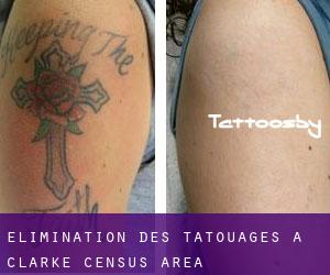 Élimination des tatouages à Clarke (census area)