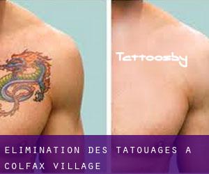 Élimination des tatouages à Colfax Village