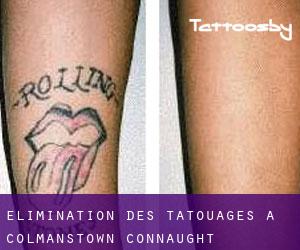 Élimination des tatouages à Colmanstown (Connaught)