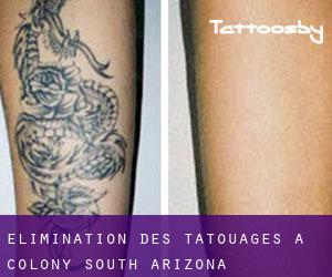 Élimination des tatouages à Colony South (Arizona)