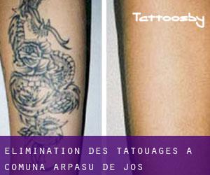 Élimination des tatouages à Comuna Arpaşu de Jos