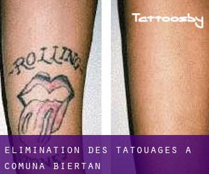 Élimination des tatouages à Comuna Biertan